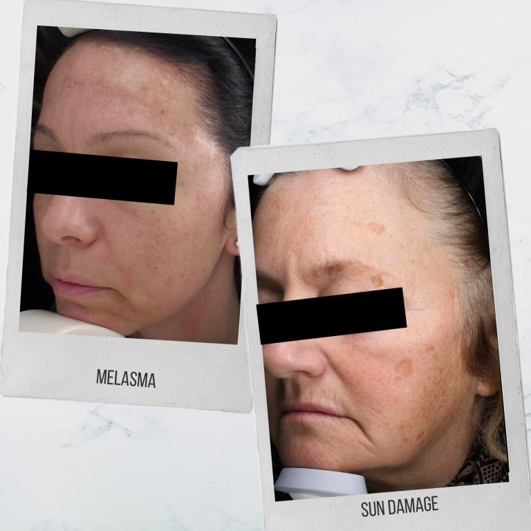 Melasma Vs Sun Damage