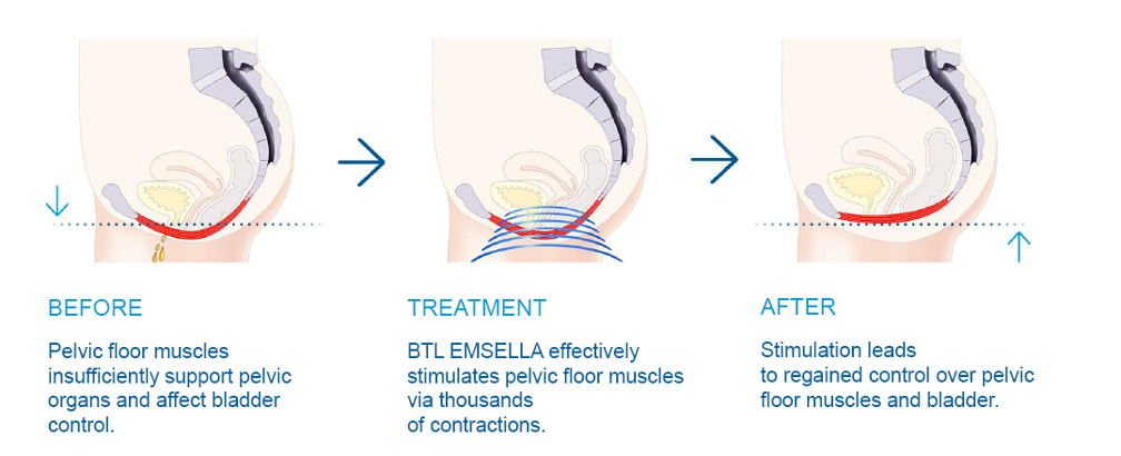 Emsella infographic describing before and after of treatment